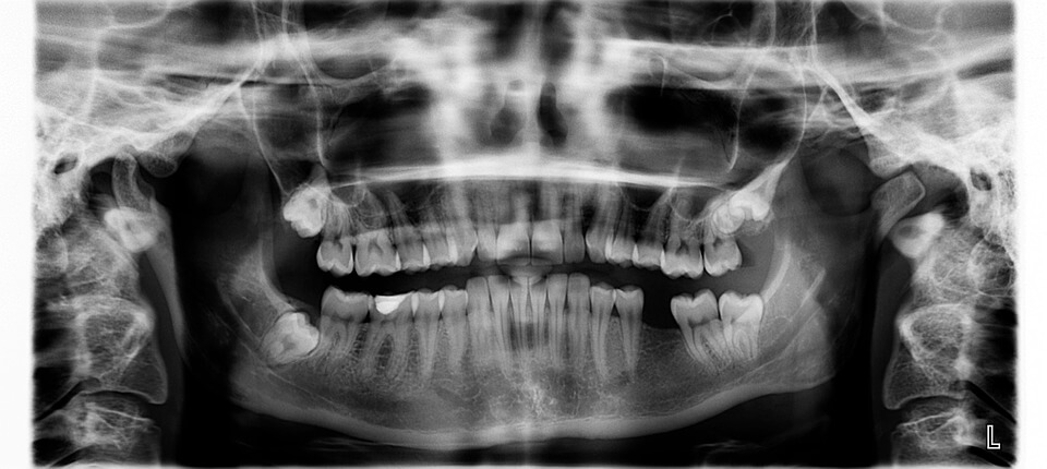 An X-ray of a jaw with missing teeth.