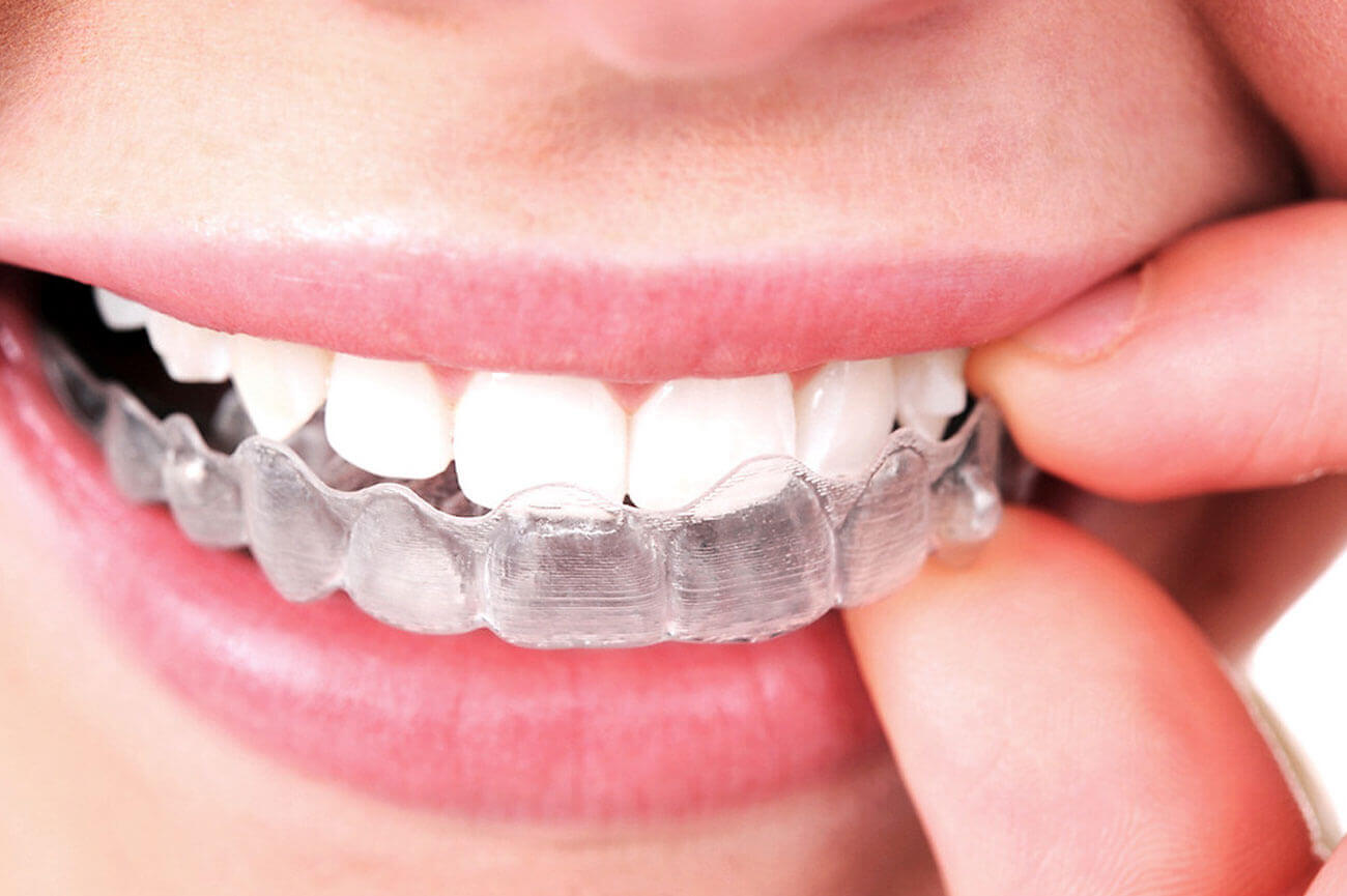 Image of woman smiling while putting in her Invisalign product